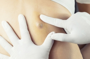 Cisti sebacee, cosa sono e perché si formano